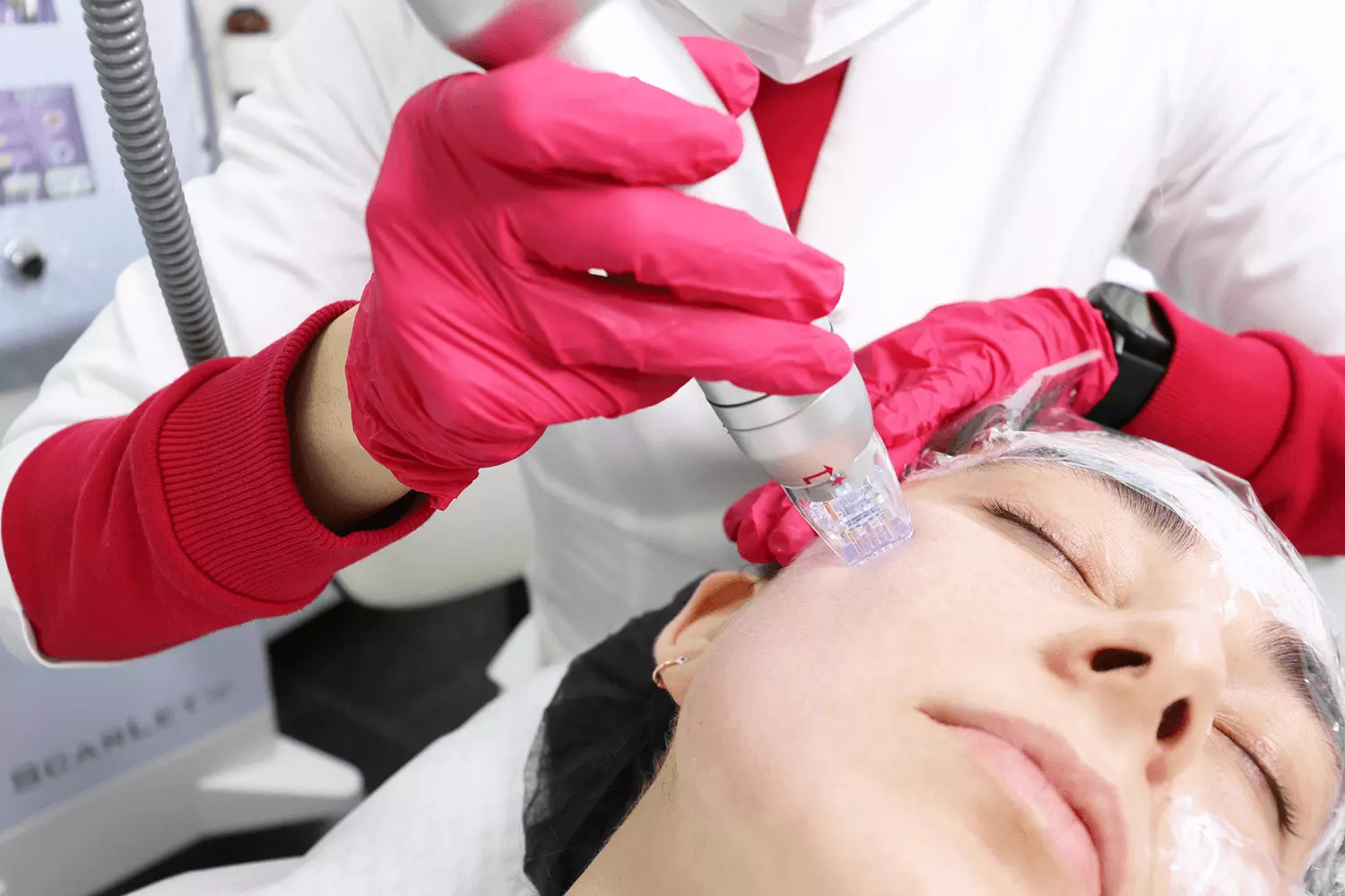 Запатентованная технология атравматичного RF